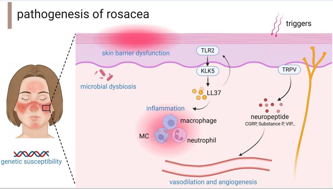 pathogenesis_rosacea